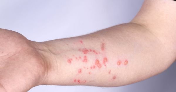 Brazil increases monkeypox testing capacity